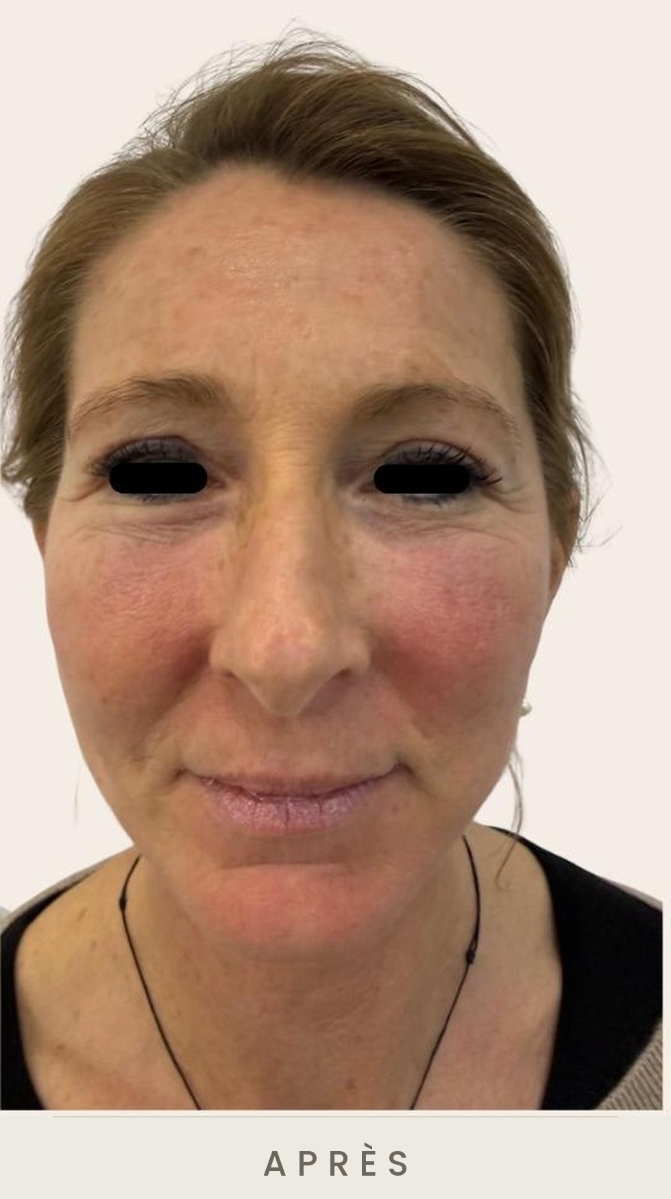 Lifting cervico-facial et blépharoplastie supérieure, vue de face après l'intervention — Dr David Ganon, chirurgien plasticien à Paris