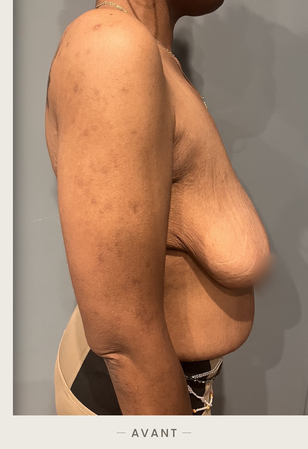 Lifting des seins par mastopexie, profil droit avant l'intervention — Dr David Ganon, chirurgien plasticien à Paris