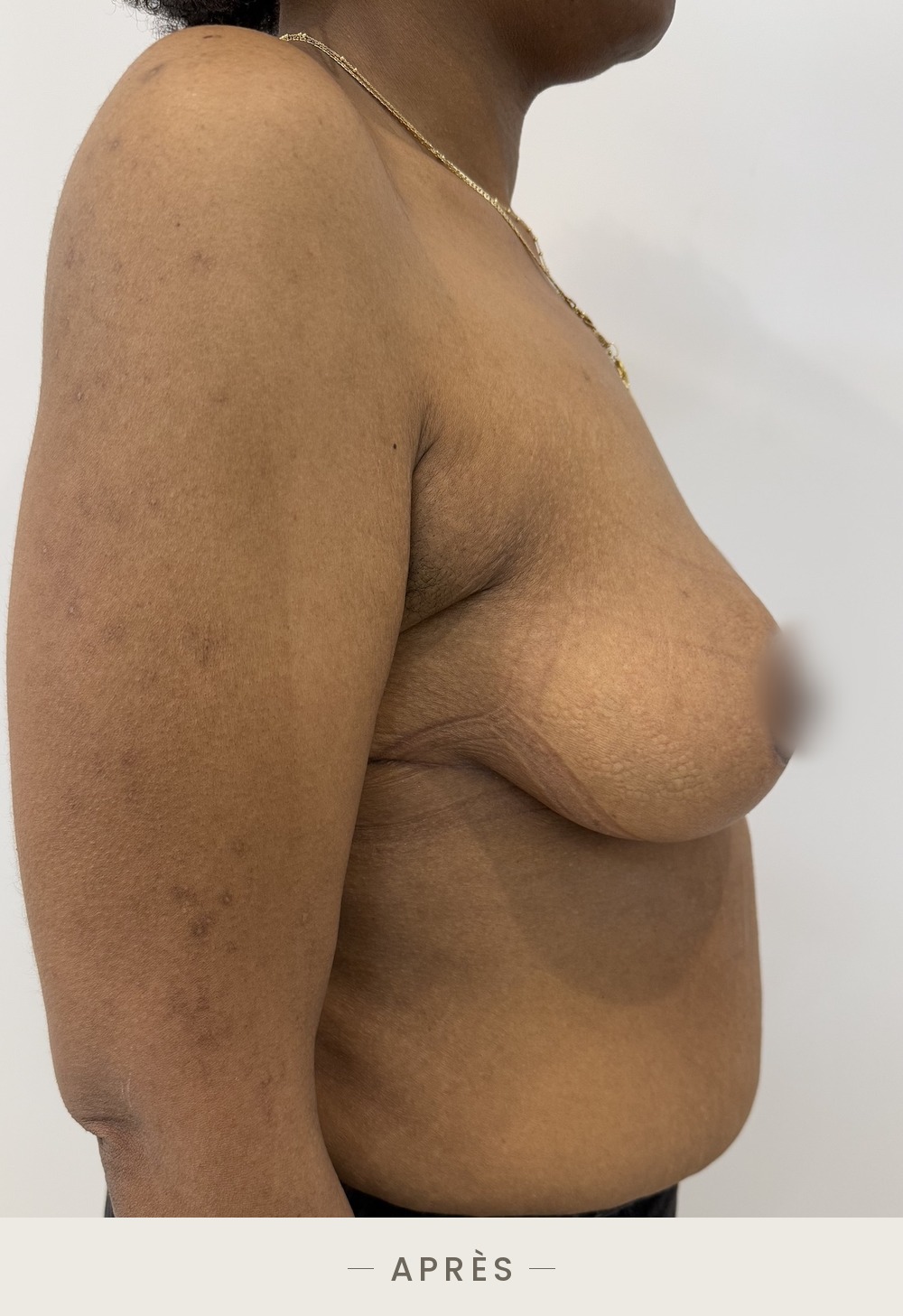 Lifting des seins par mastopexie, profil droit après l'intervention — Dr David Ganon, chirurgien plasticien à Paris
