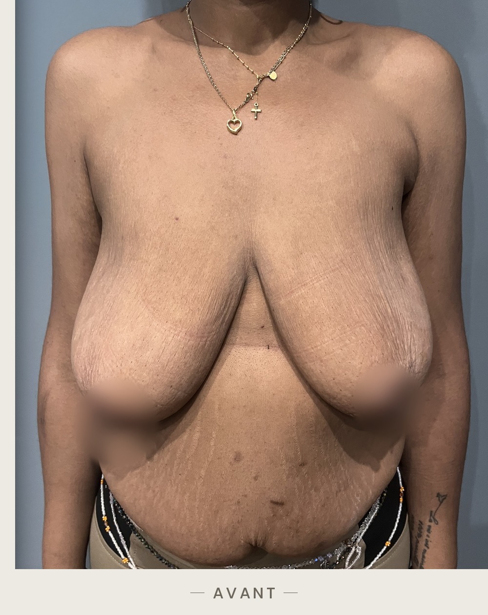 Lifting des seins par mastopexie, vue de face avant l'intervention — Dr David Ganon, chirurgien plasticien à Paris