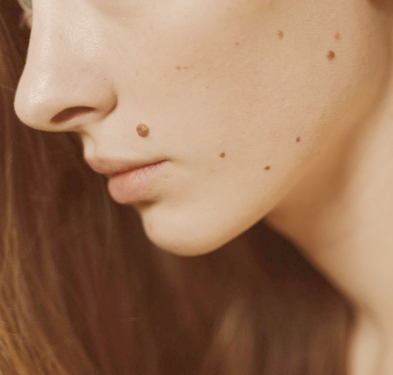 Profil d'un visage portant plusieurs grains de beauté sur la joue et le cou
