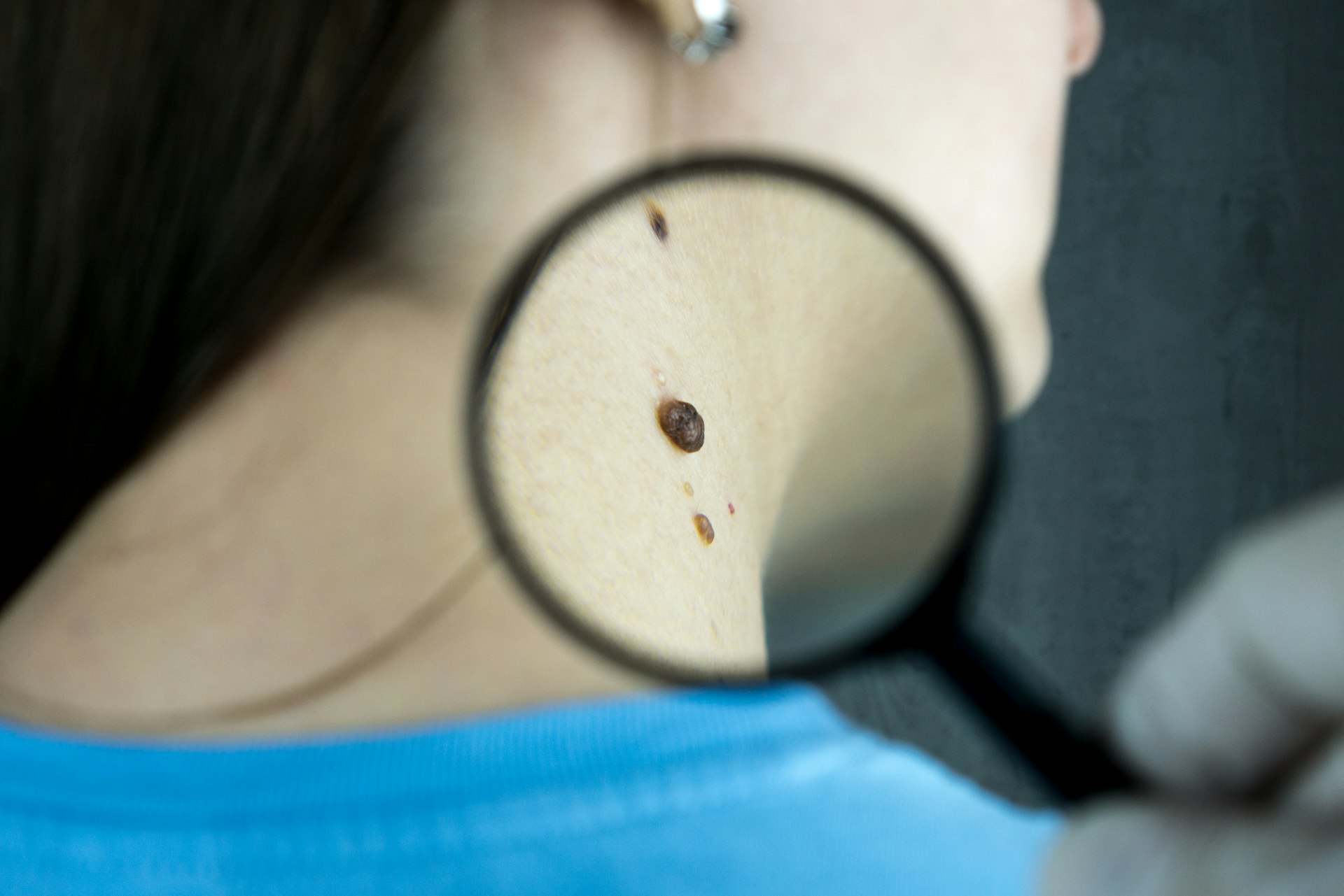 Examen d'un grain de beauté à la loupe avant son retrait
