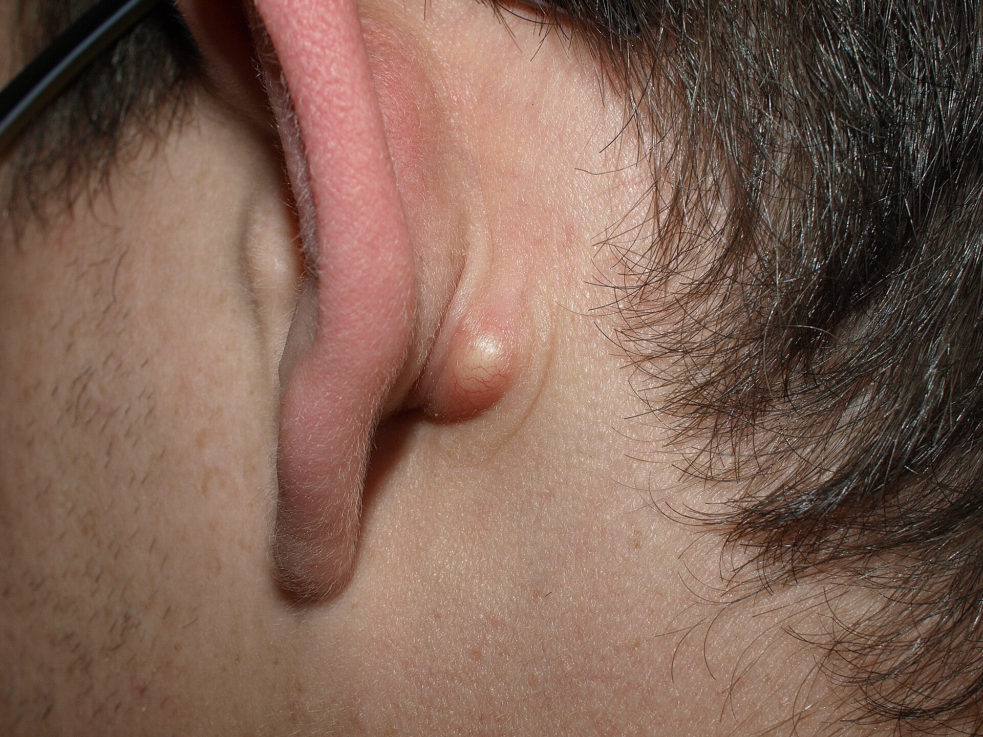 Kyste sébacé derrière le lobe de l'oreille