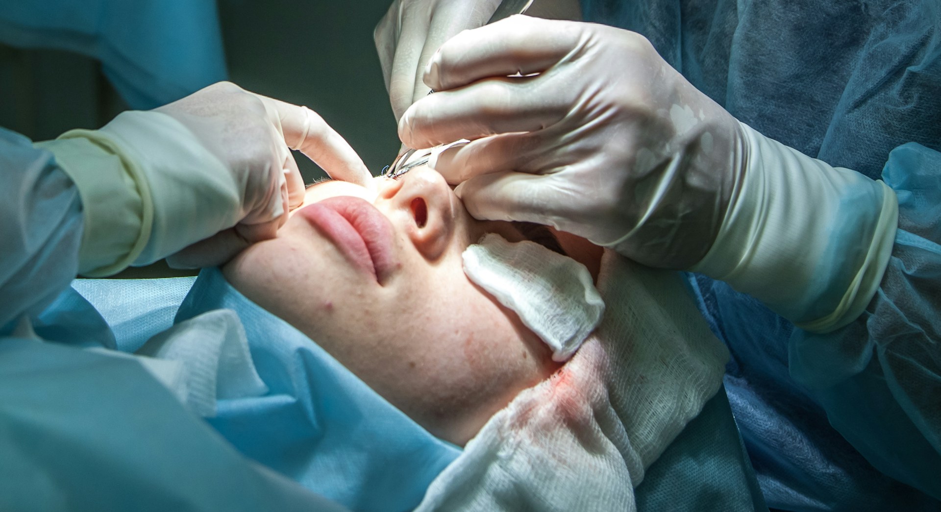 Suture fine sur le visage, près du nez, au bloc opératoire