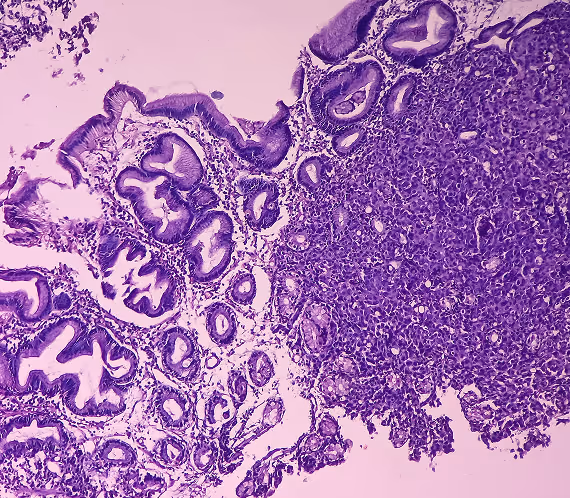 Microscopic image of solid tumor tissue