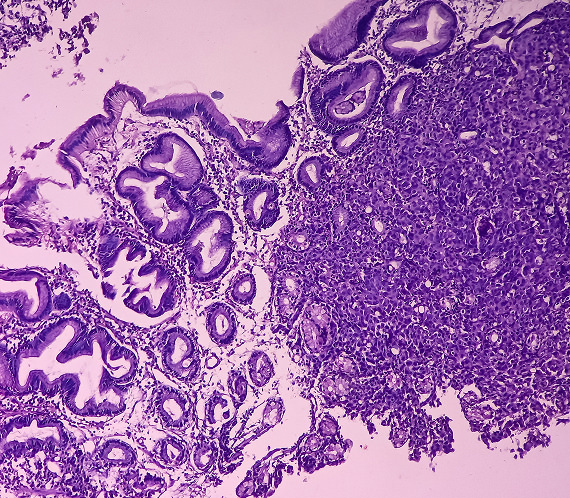 Microscopic image of solid tumor tissue