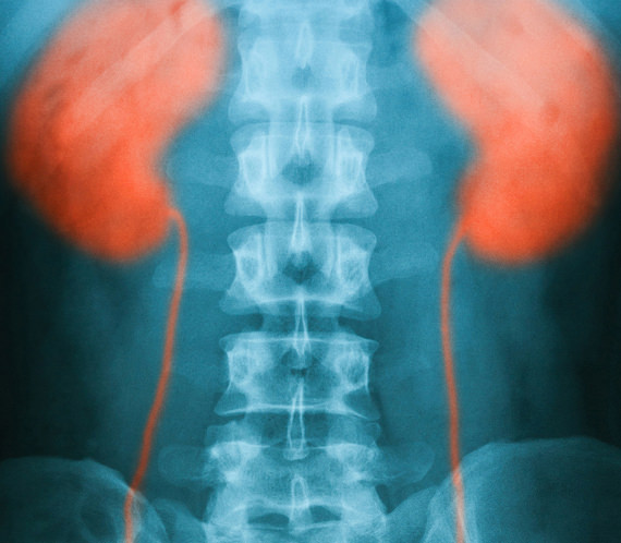 Scan showing non-cancerous kidney condition