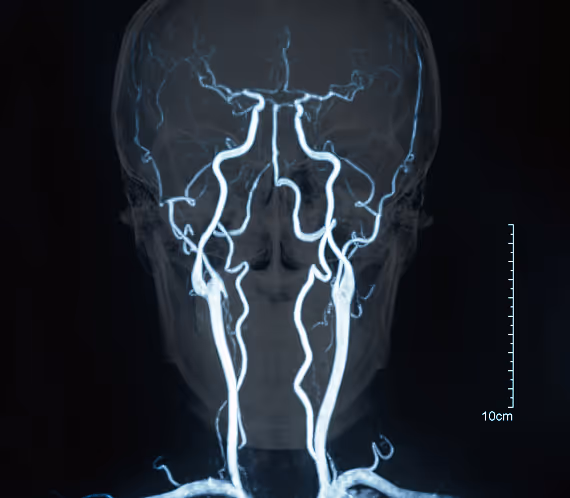 Head MRI showing brain aneurysms