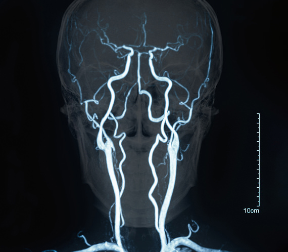 Head MRI showing brain aneurysms