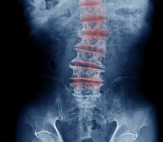 Spinal degeneration X-ray scan