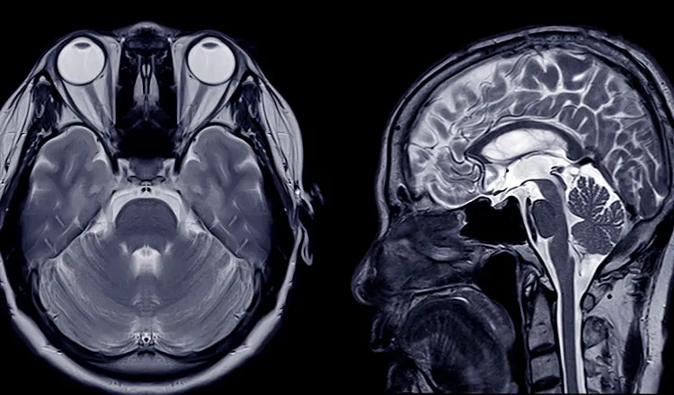 Close-up MRI scans of the brain in grayscale