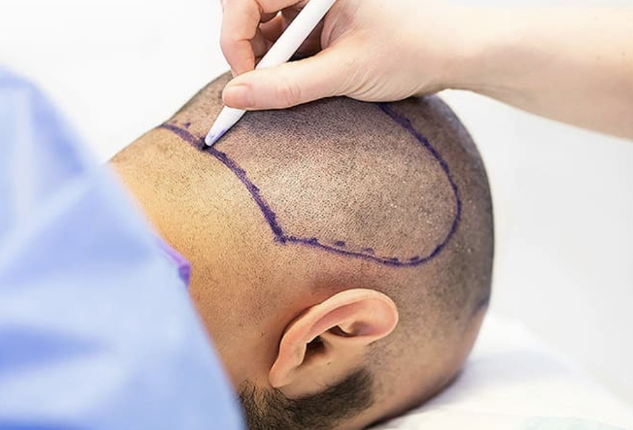 Zone donneuse greffe de cheveux - Maison Apogée