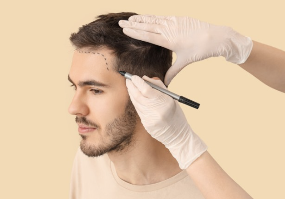 Greffe cheveux vs traitements redensifiants - Maison Apogée