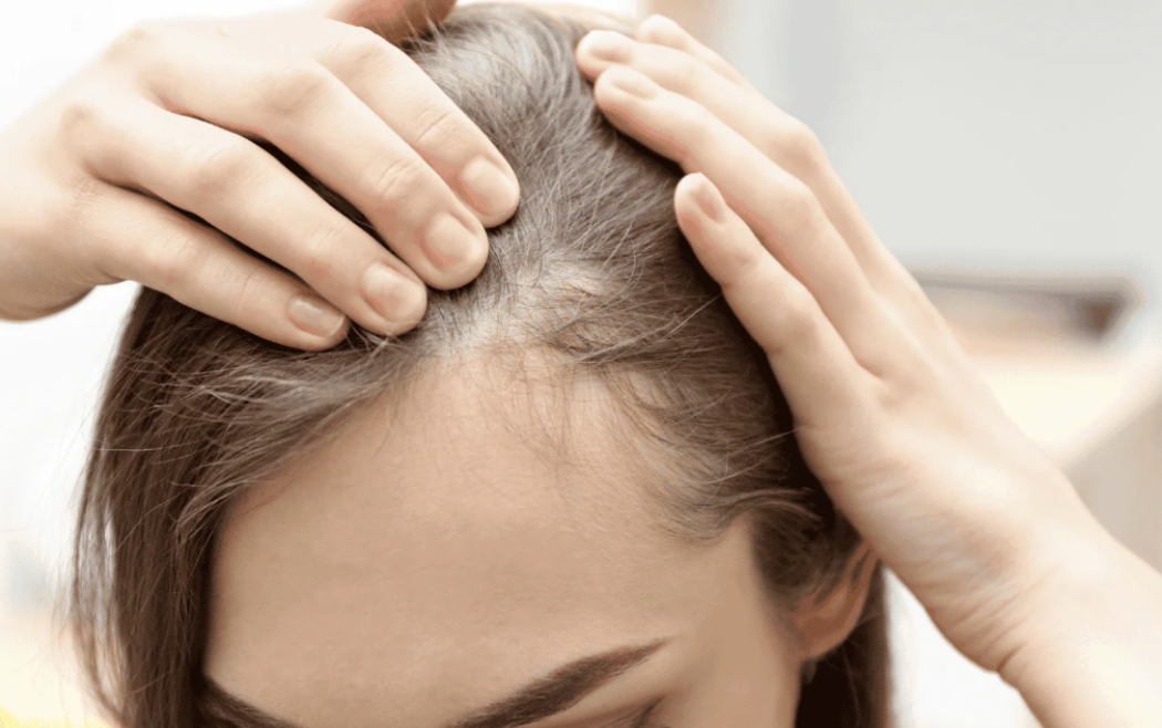 Chute de cheveux féminine après grossesse traitements - Maison Apogée