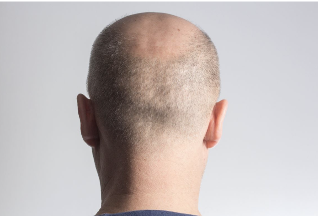 Greffe cheveux calvitie ancienne - Maison Apogée