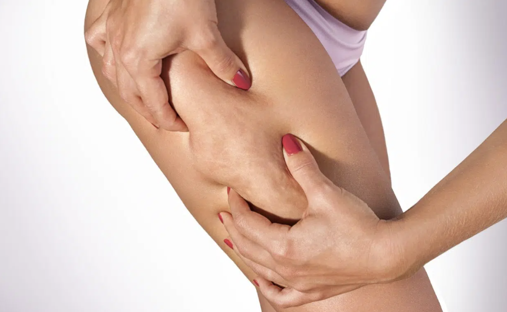 Solutions cellulite Apogée Paris