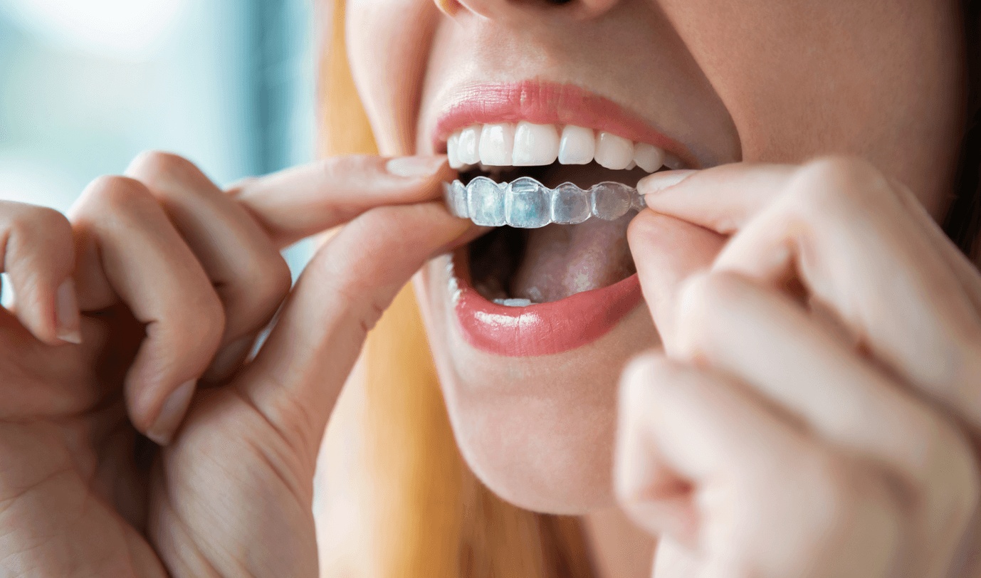 Person placing clear aligner on teeth, highlighting the benefits of Invisalign with guidance from the best dentist for Invisalign in Miami.
