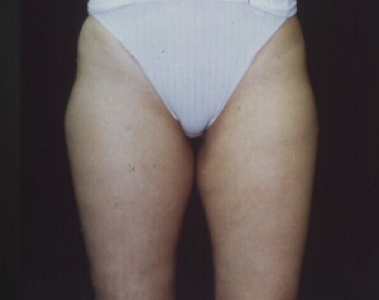 This is an example of a basal cell carcinoma.
