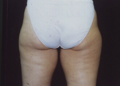 This is an example of a basal cell carcinoma.