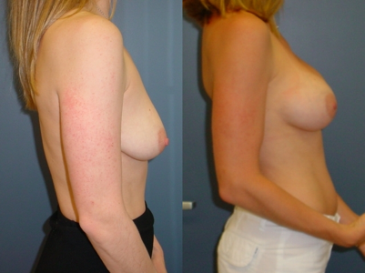 This is an example of a basal cell carcinoma.