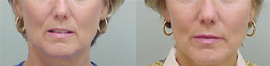 This is an example of a basal cell carcinoma.
