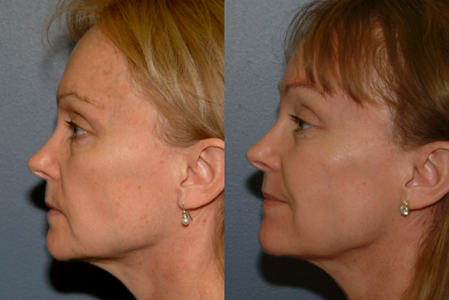 This is an example of a basal cell carcinoma.