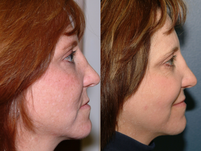 This is an example of a basal cell carcinoma.