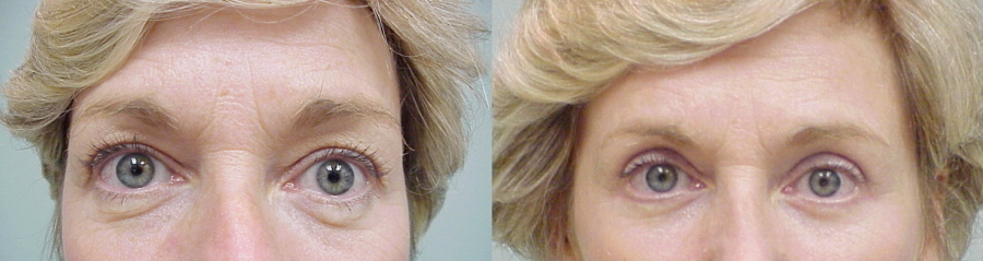 This is an example of a basal cell carcinoma.