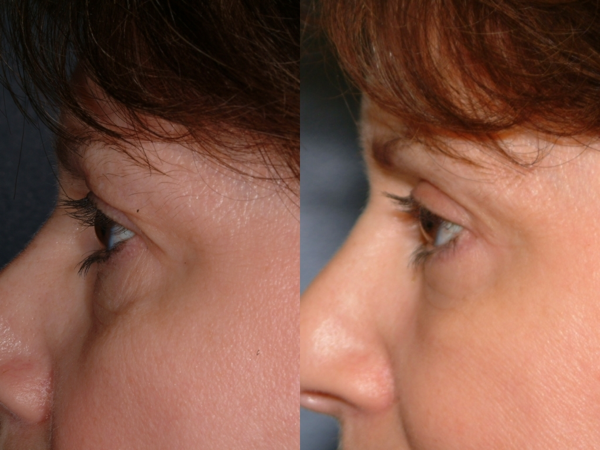 This is an example of a basal cell carcinoma.