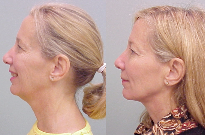 This is an example of a basal cell carcinoma.