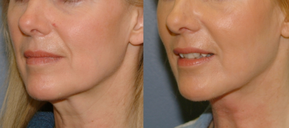 This is an example of a basal cell carcinoma.