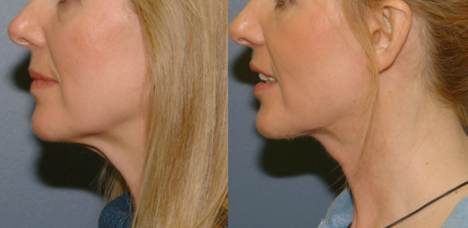 This is an example of a basal cell carcinoma.