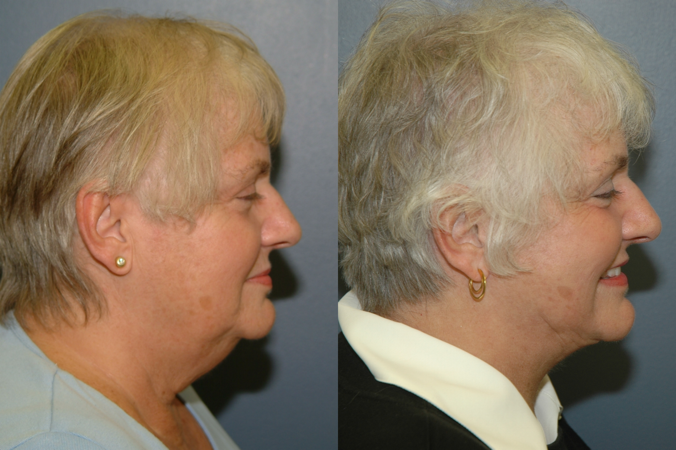 This is an example of a basal cell carcinoma.