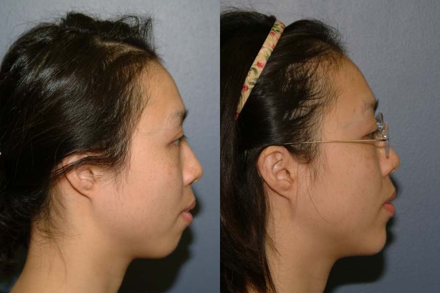 This is an example of a basal cell carcinoma.