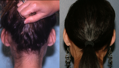 This is an example of a basal cell carcinoma.