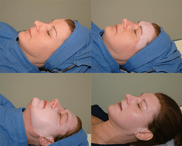 This is an example of a basal cell carcinoma.
