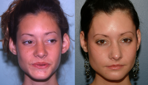 This is an example of a basal cell carcinoma.