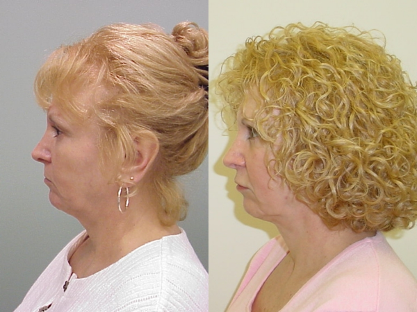 This is an example of a basal cell carcinoma.