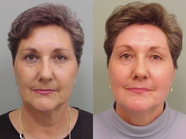 This is an example of a basal cell carcinoma.