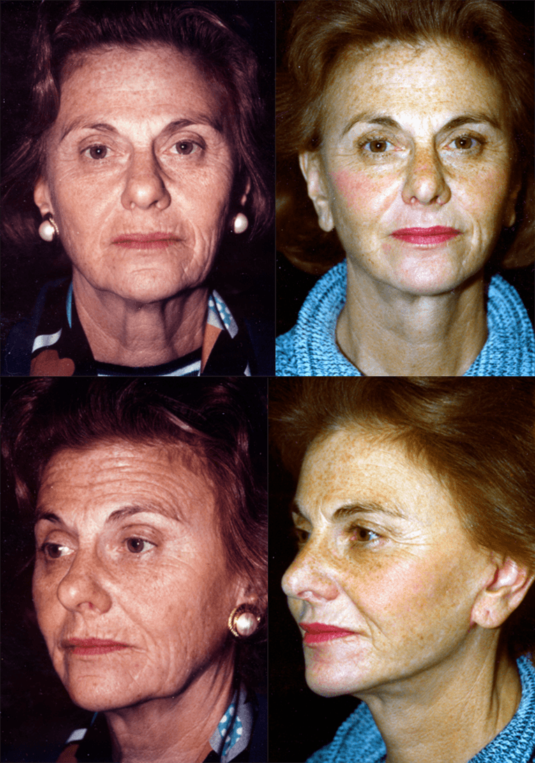 This is an example of a basal cell carcinoma.