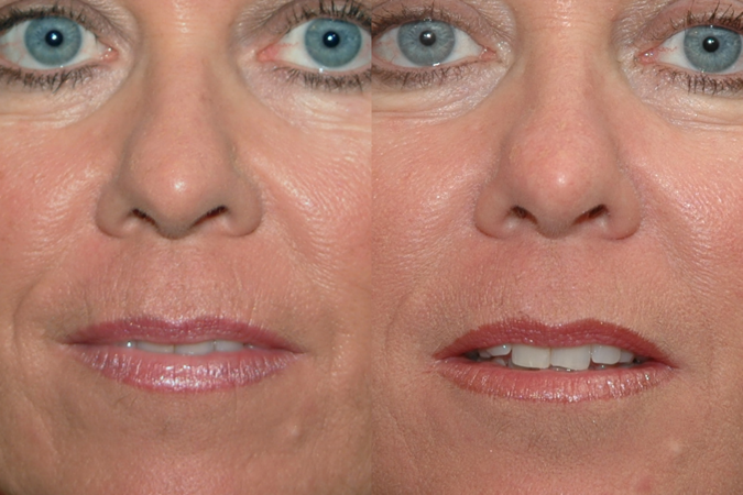This is an example of a basal cell carcinoma.