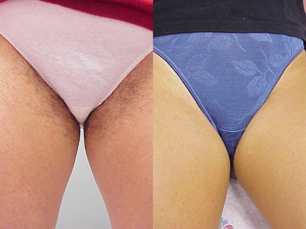 This is an example of a basal cell carcinoma.