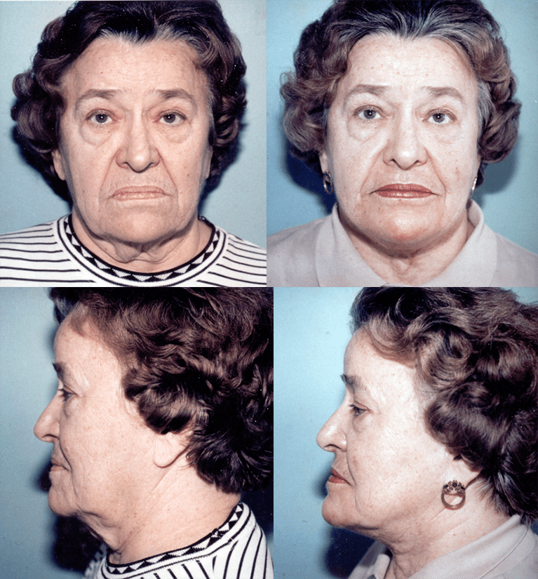 This is an example of a basal cell carcinoma.
