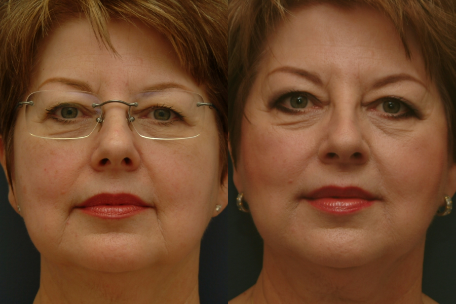 This is an example of a basal cell carcinoma.