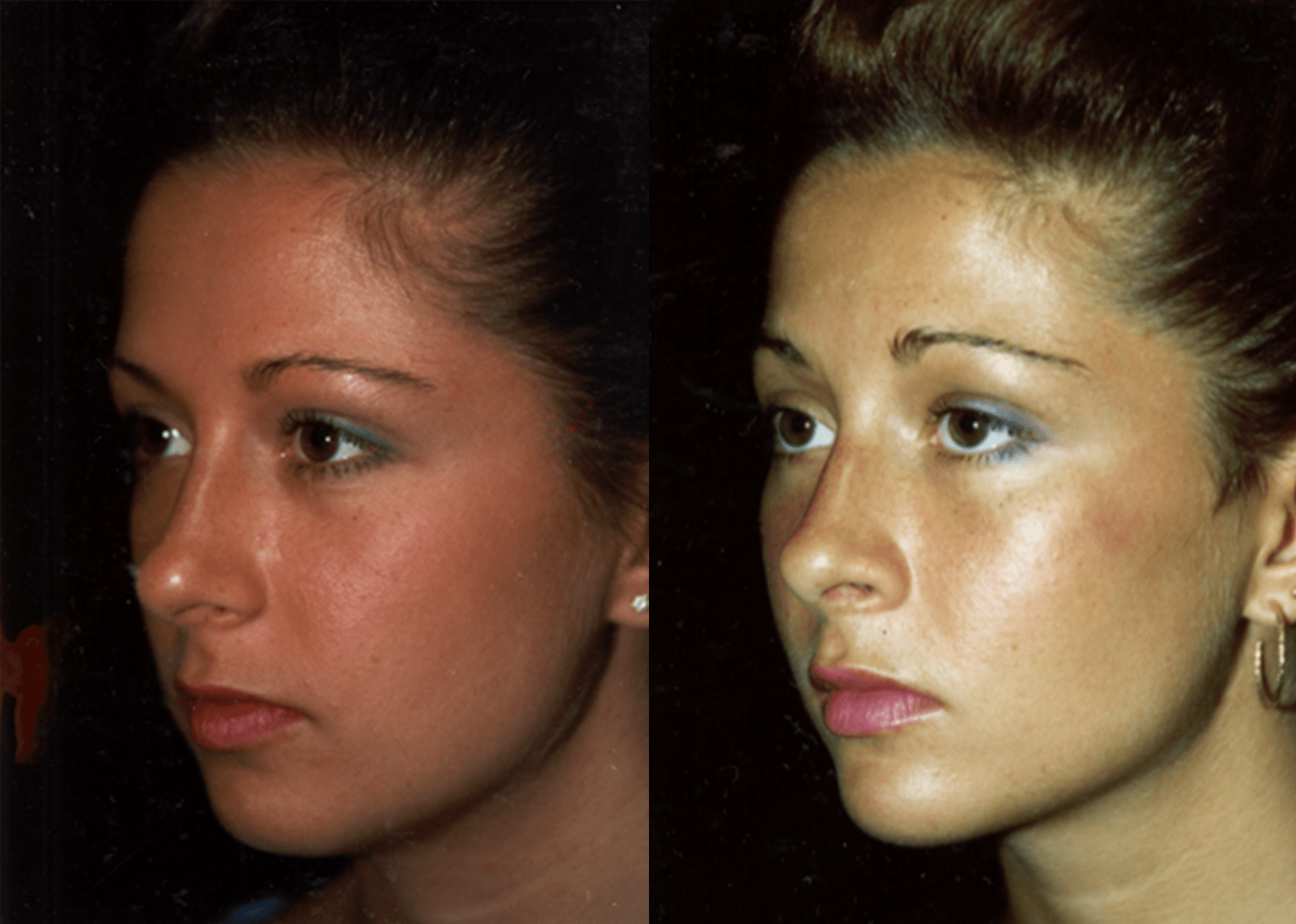 This is an example of a basal cell carcinoma.