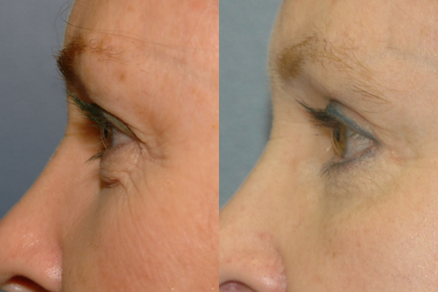 This is an example of a basal cell carcinoma.