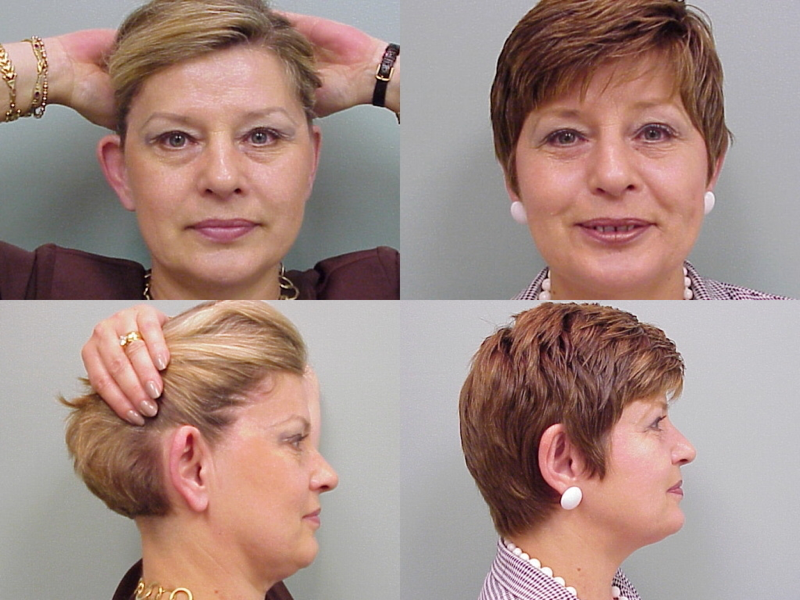This is an example of a basal cell carcinoma.
