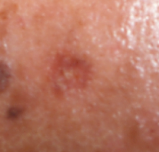 This is an example of a basal cell carcinoma.