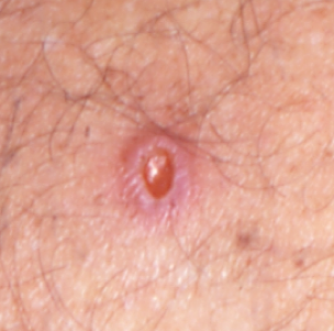 This is an example of a basal cell carcinoma.