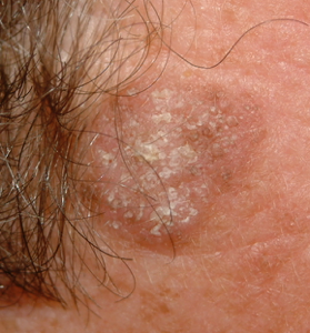 This is an example of a basal cell carcinoma.